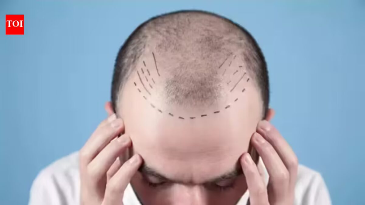 Days after TN order, docs search related guidelines nationwide as hair transplant growth raises security alarm | India Information